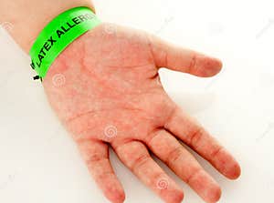 Latex Allergy Rash Stock Image Image 36243311