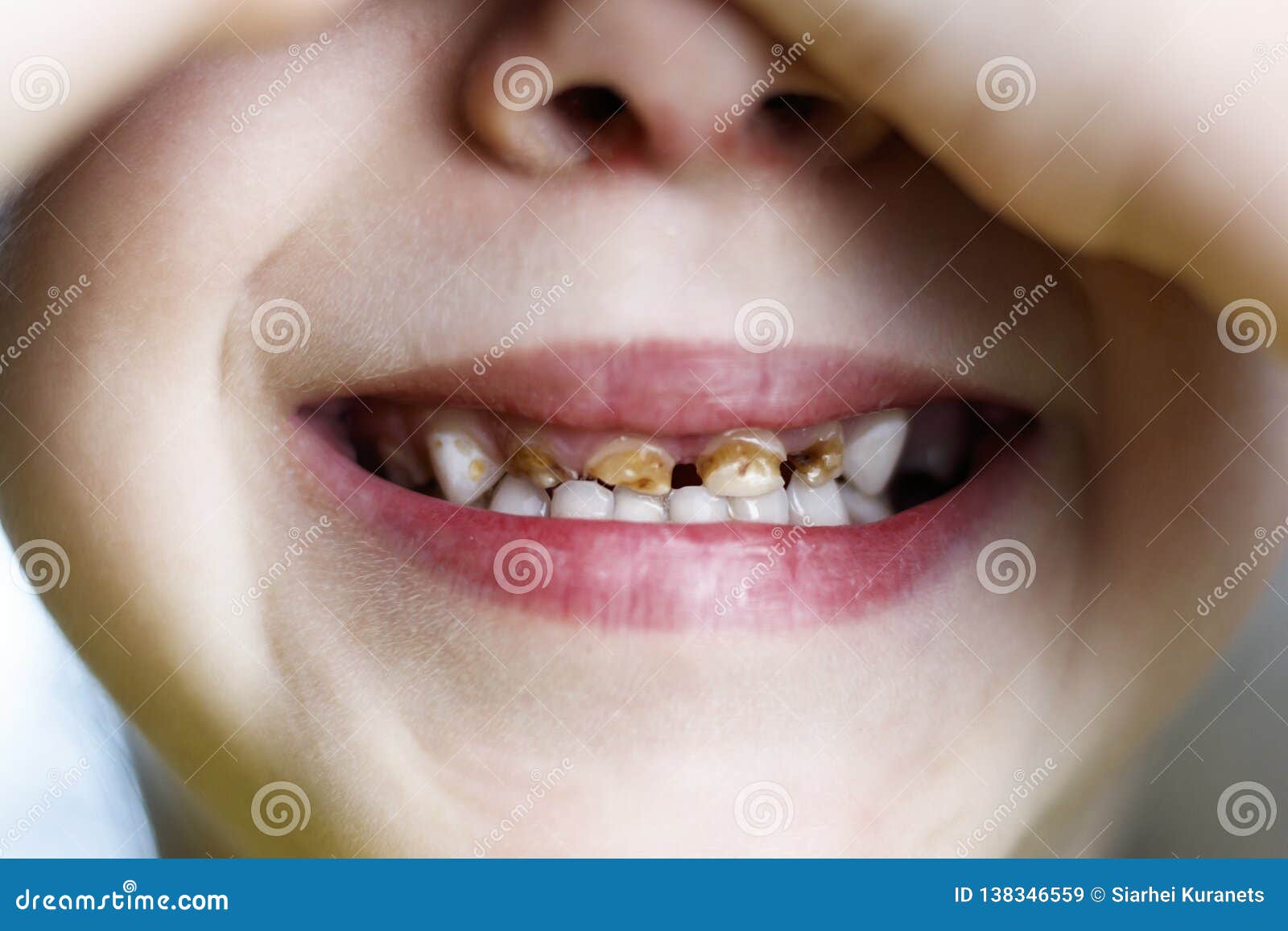 Le Bebe Est Dans La Chaise Au Dentiste Que Les Mains Ferme Ses Yeux Dents Avant Dans Les Caries Profondeur De Coupe La Modifie La Image Stock Image Du Croissance Dentiste