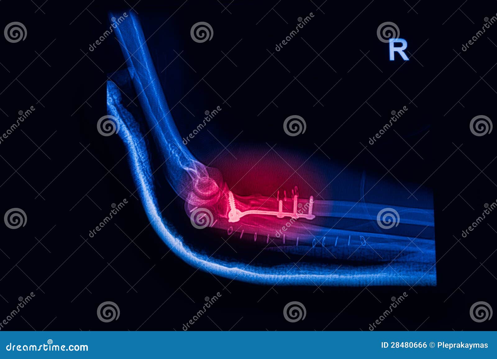 Le Coude De Fracture, Avantbras Radiographie L'image Photo stock