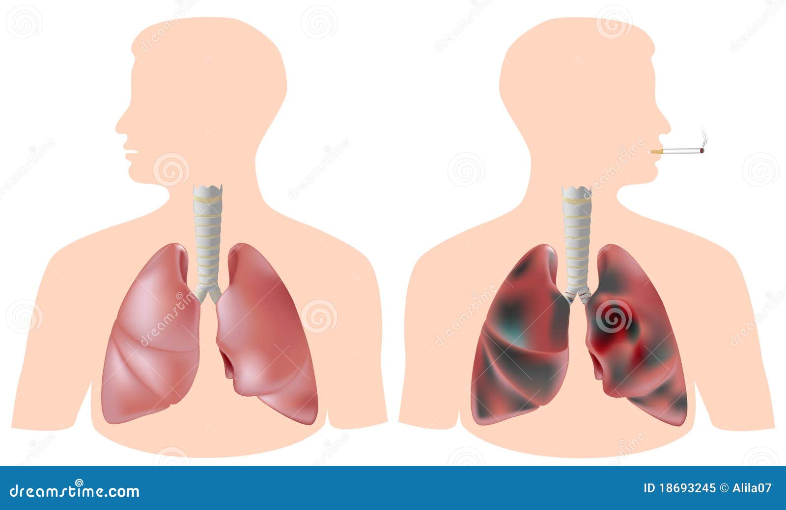Le Poumon Du Fumeur Avec La Tumeur Contre Le Poumon Sain Illustration De Vecteur Illustration Du Bronches Bronchiole