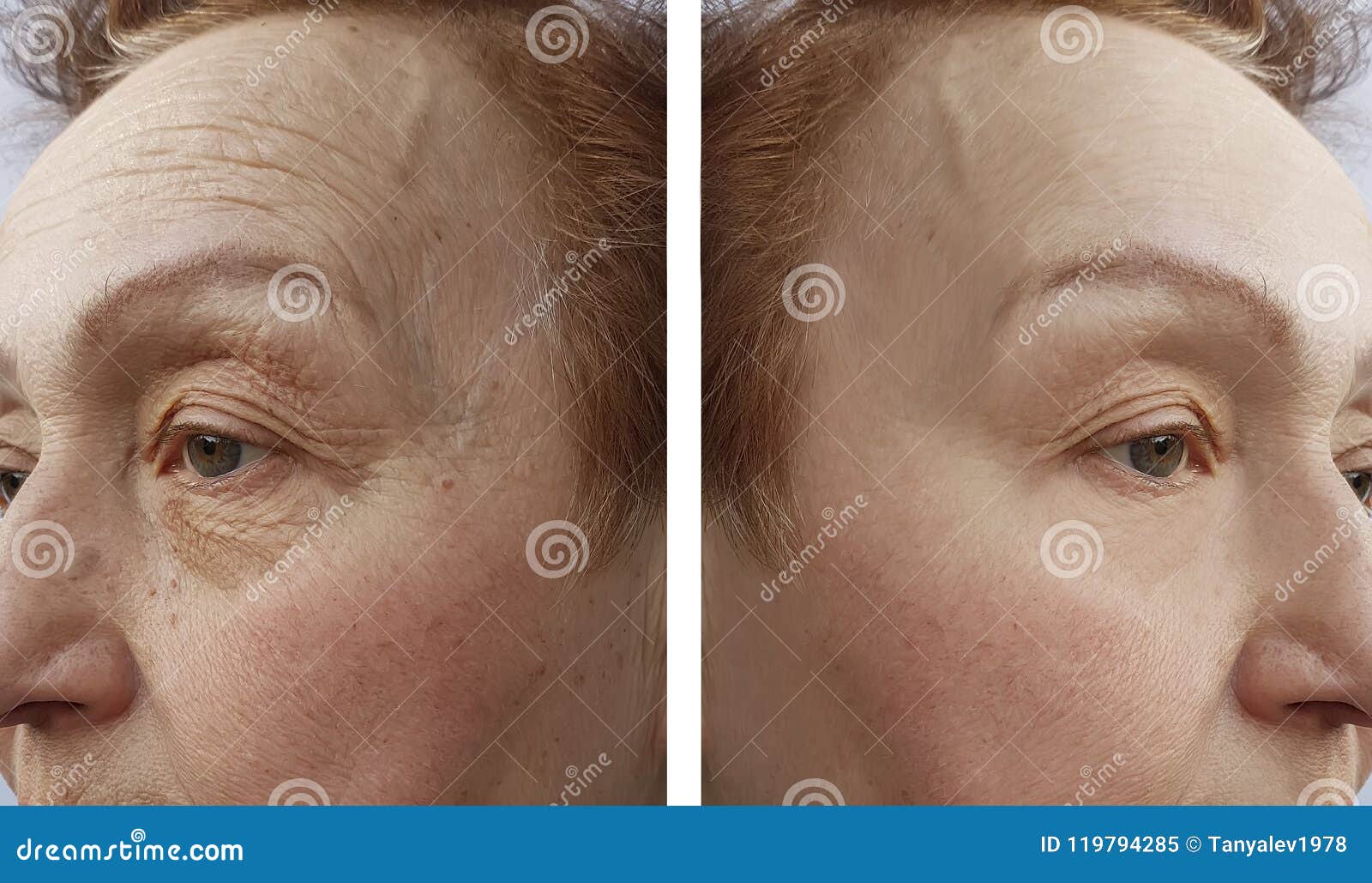 Le Visage D Une Femme Agee Ride La Procedure De Dermatologie Avant Et Le R Aftetherapy Image Stock Image Du Vieillissement Levage Le Visage D Une Femme Agee Ride La Procedure De Dermatologie Avant Et Le R Aftetherapy Image Stock Image Du Vieillissement Levage