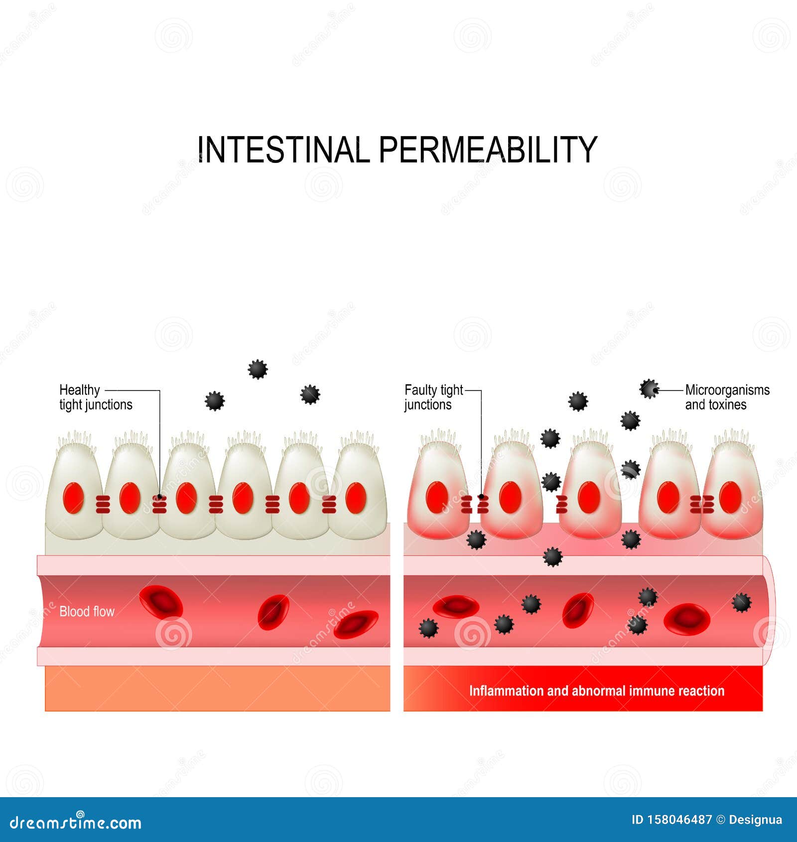 leaky gut. intestinal permeability