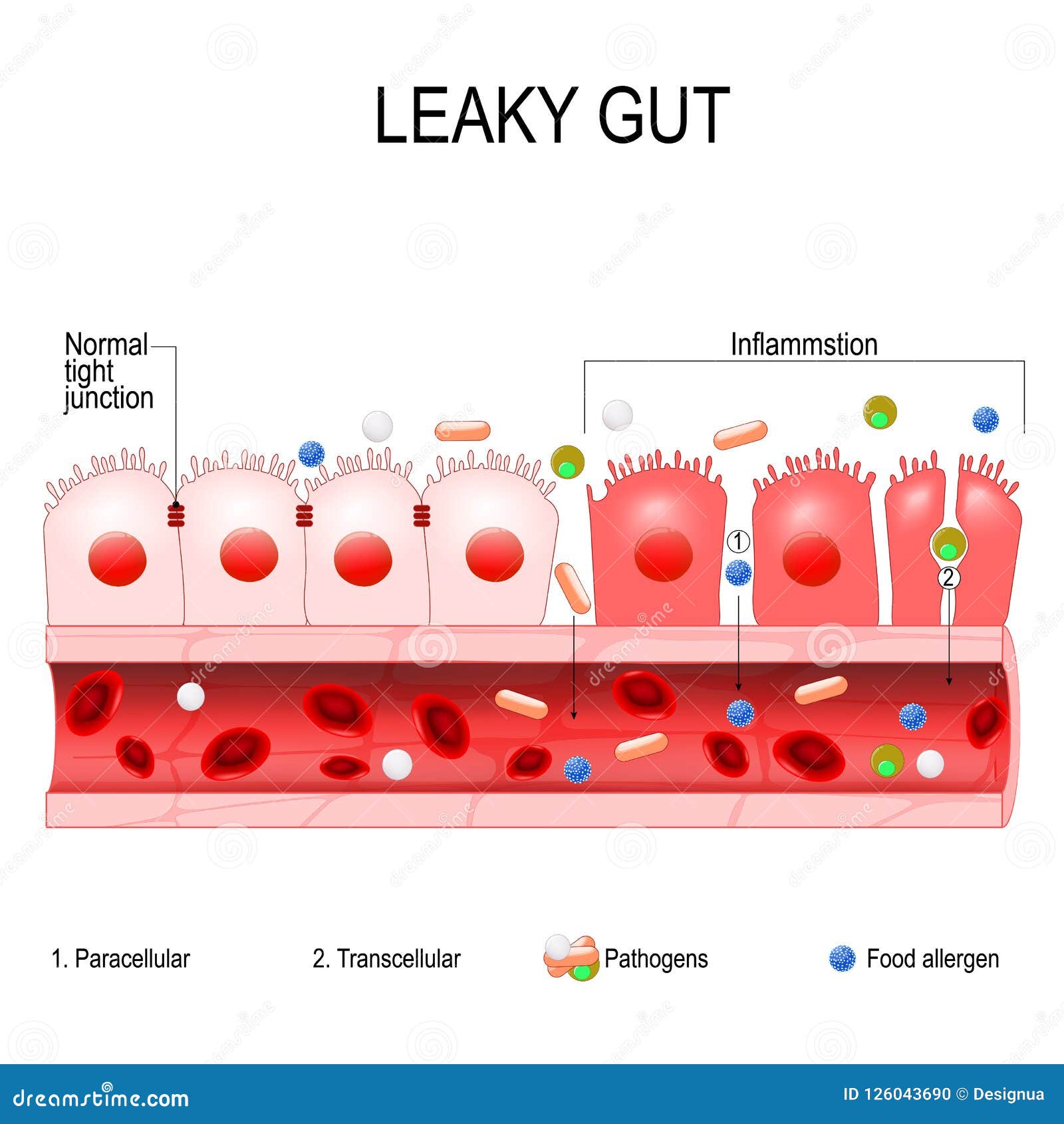 leaky gut