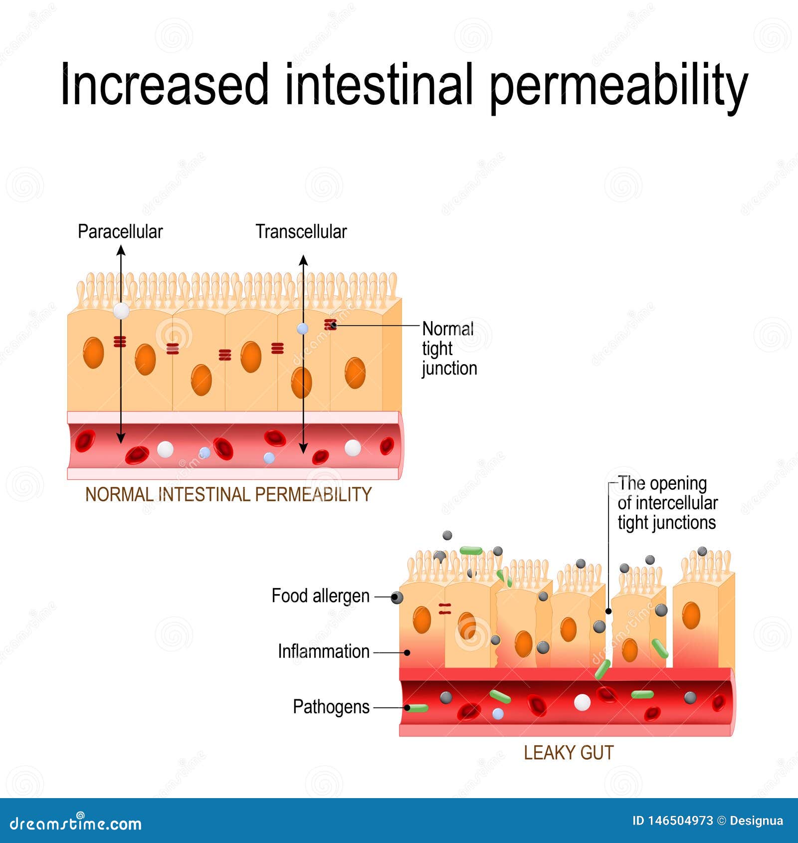 leaky gut. the opening of intercellular tight junctions increased intestinal permeability