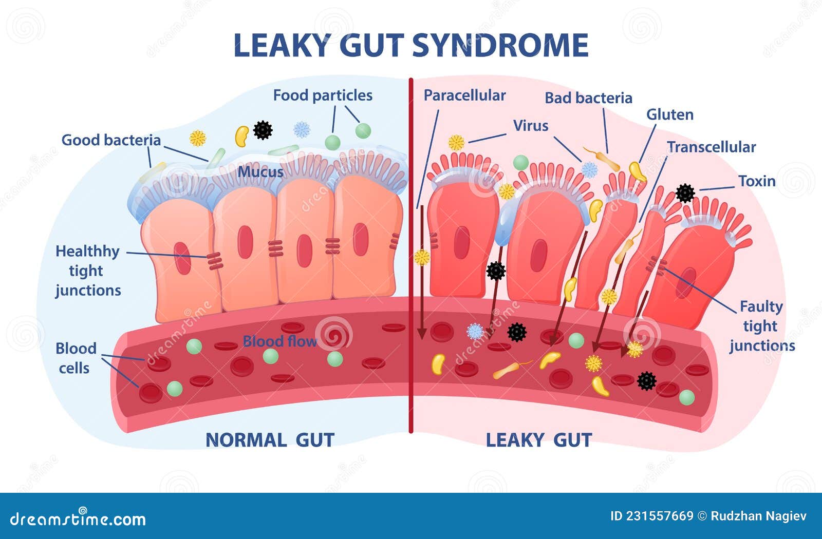 leaky gut syndrome concept