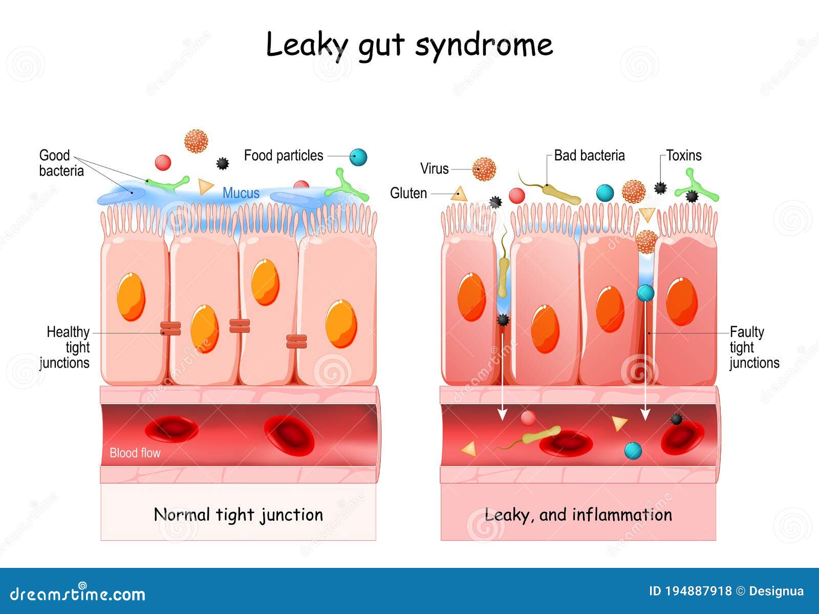 leaky gut syndrome