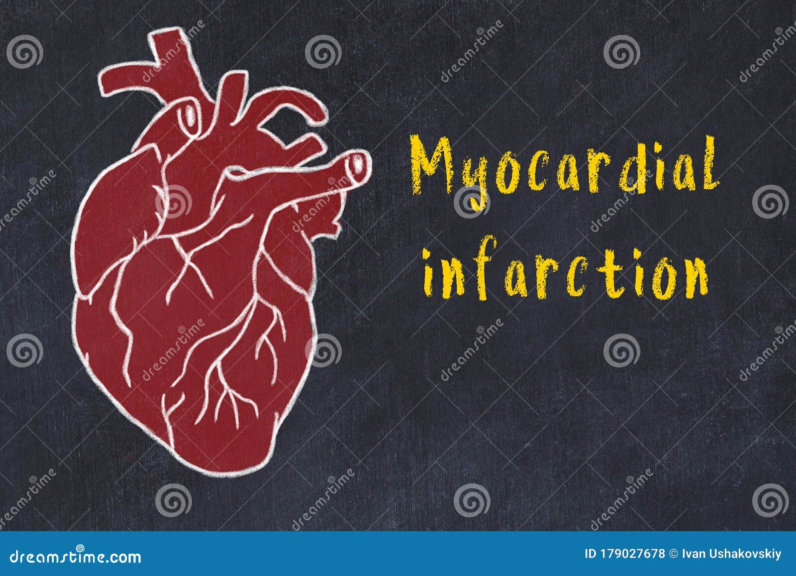 Myocardial Infarction Cartoon Vector | CartoonDealer.com #22600741