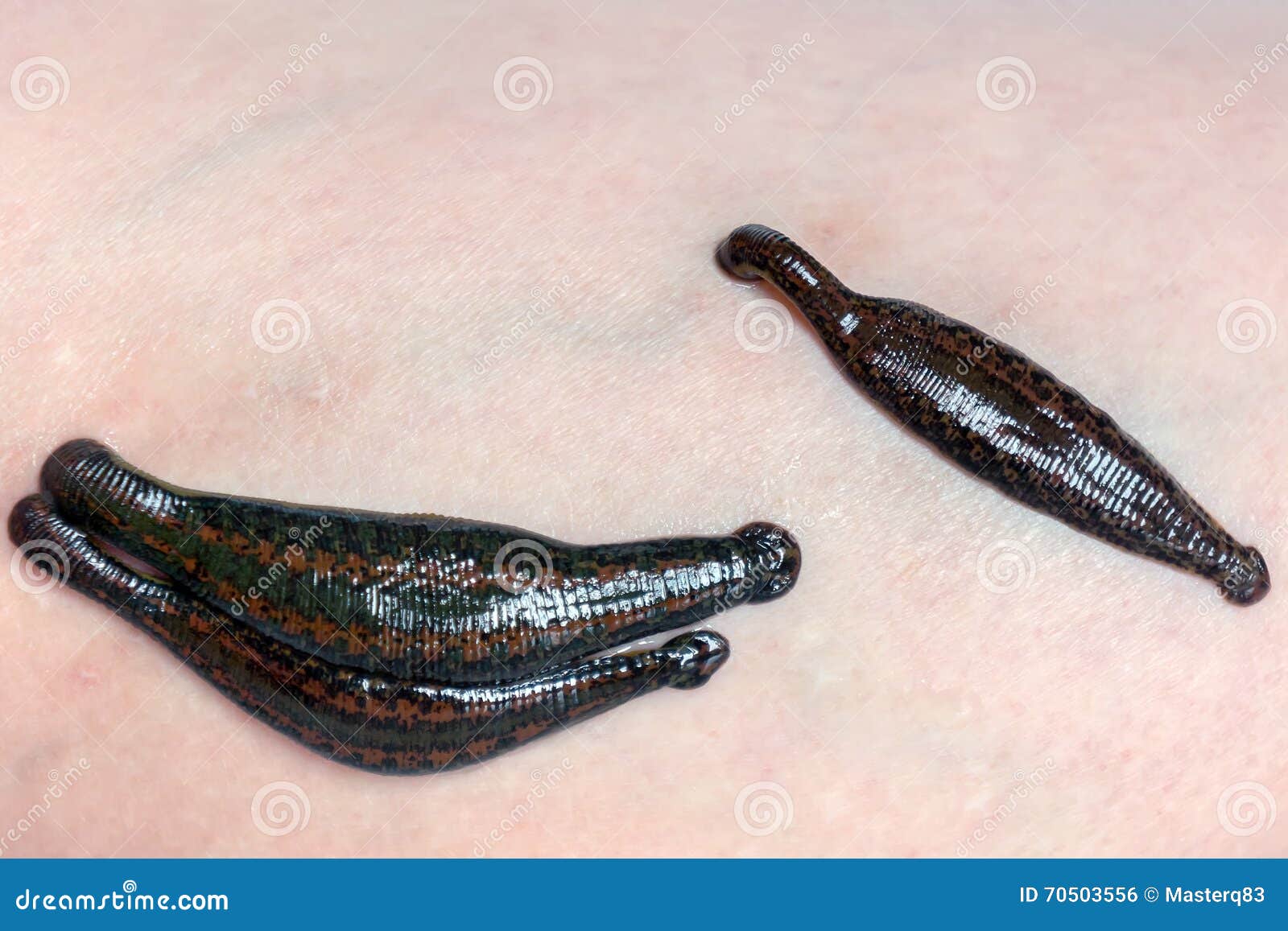 Leeches on the skin stock photo. Image of parasite, group 70503556