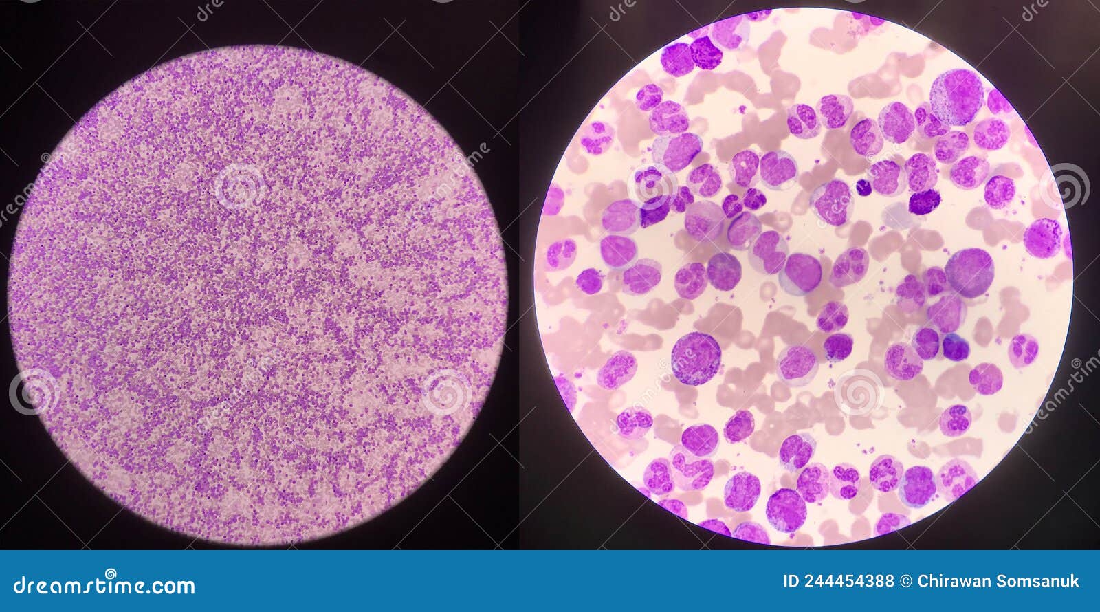Left Anormal Blood Smear 10x Microscope,Right Anormal Blood Smear 100x