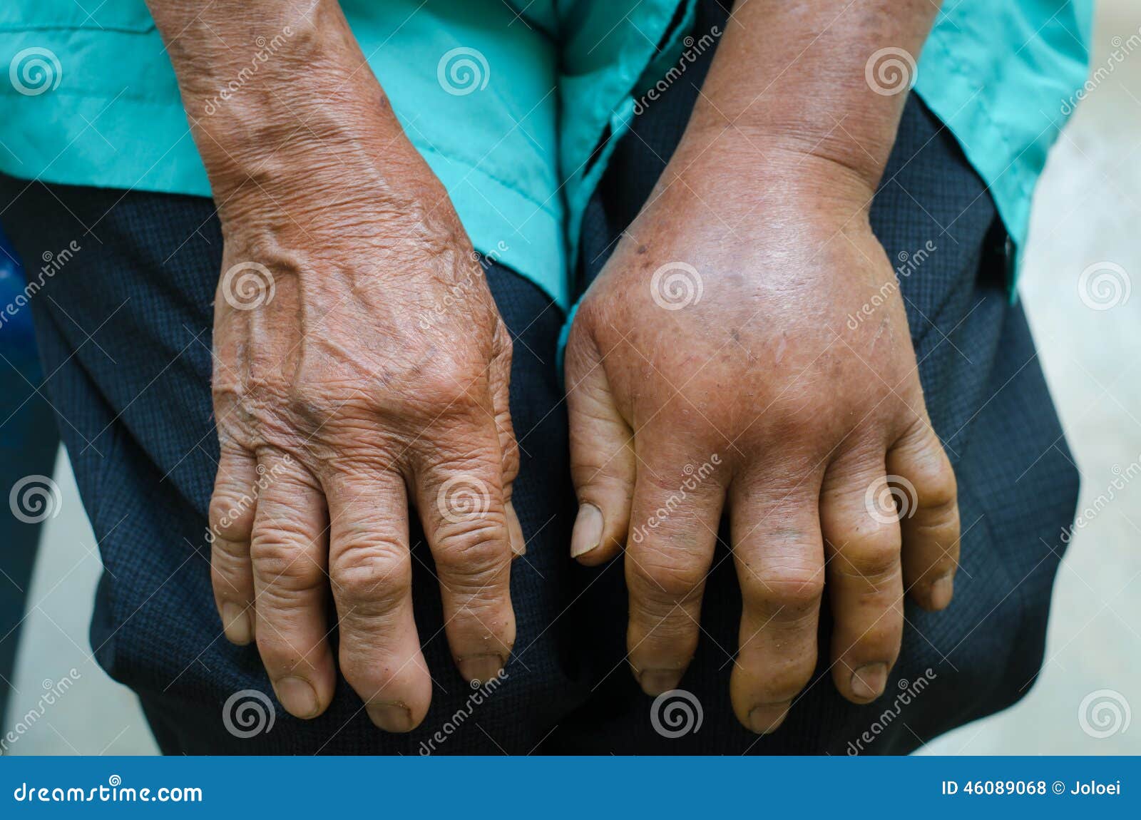 left hand inflammation