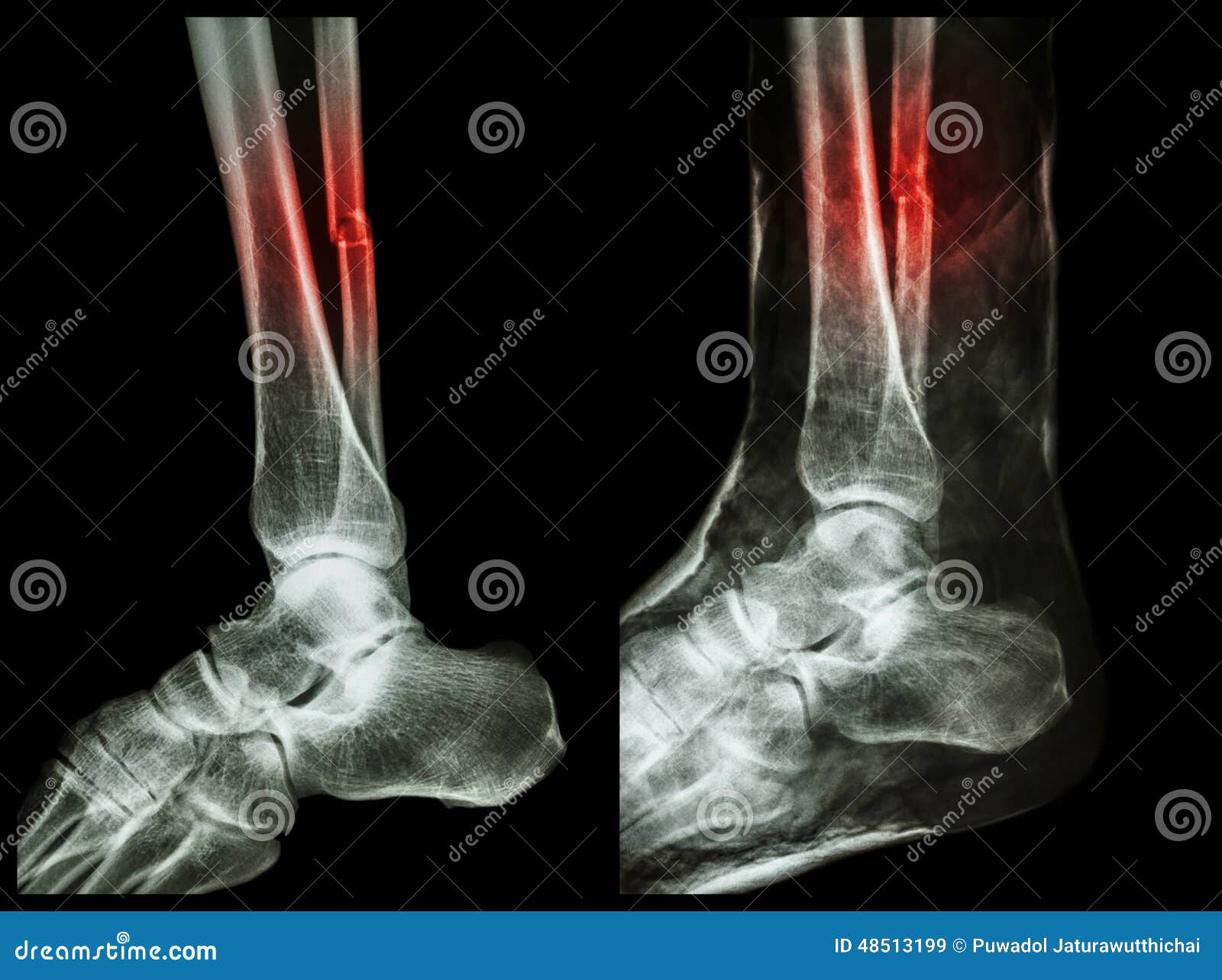 left image : fracture shaft of fibula (calf bone) , right image : it was splinted with plaster cast