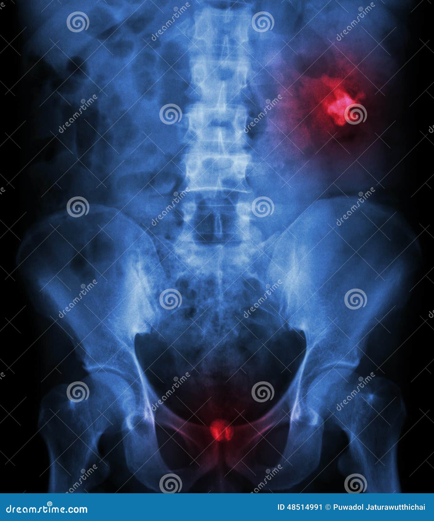 Left Kidney Stone(opaque Area at Right Upper of Image) and Bladd Stock