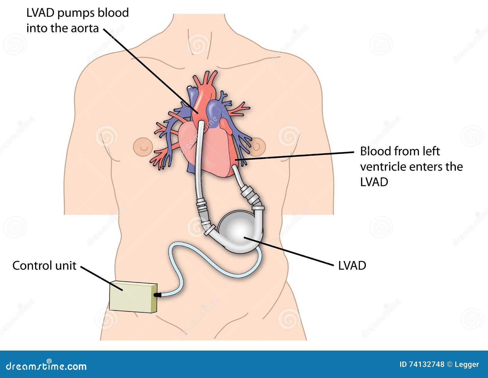 left ventricular assist device (lvad)