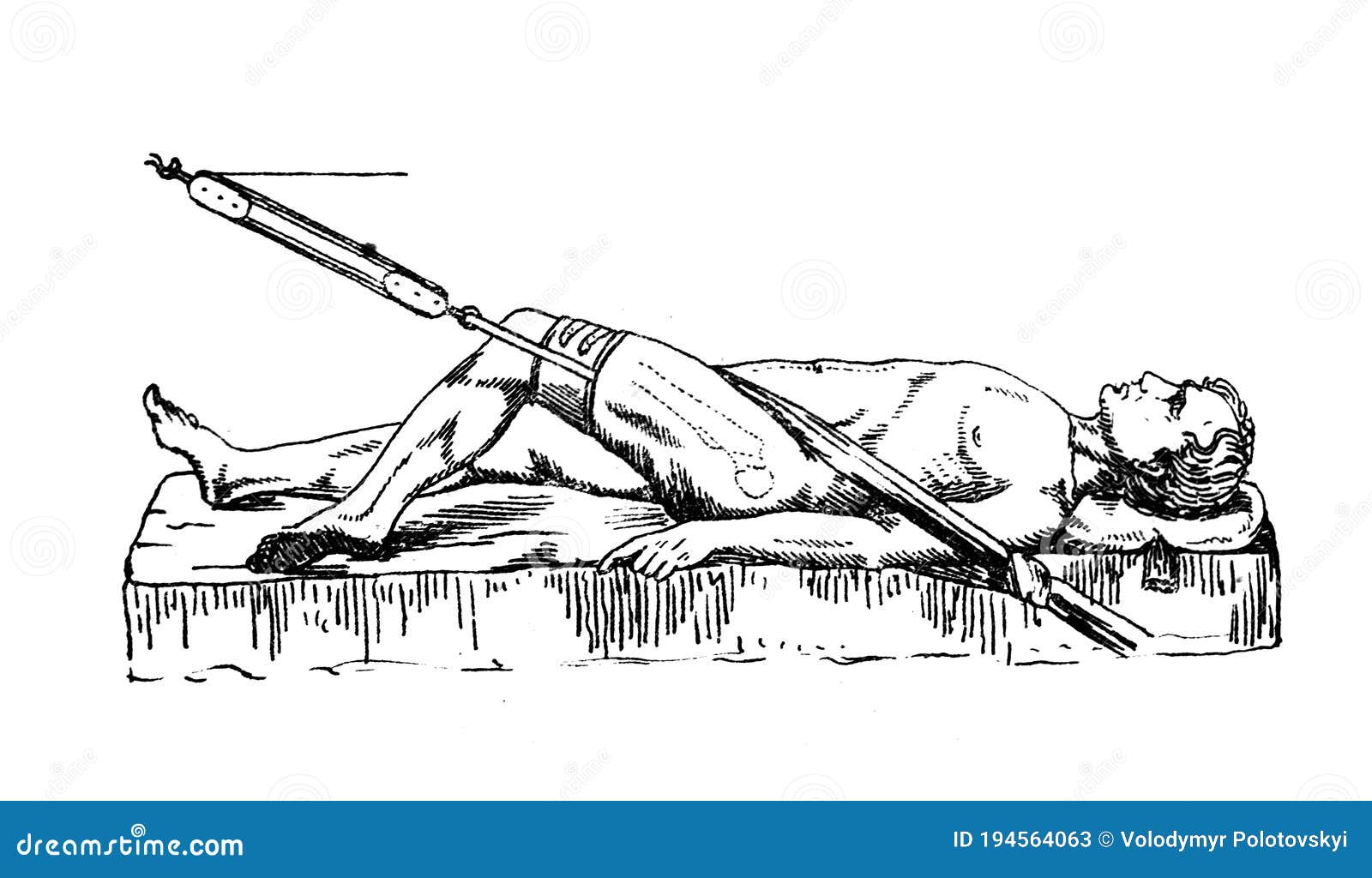 leg fracture fixation in the old book the doctrine of fractures and dislocations by nemmert, st. petersburg, 1851