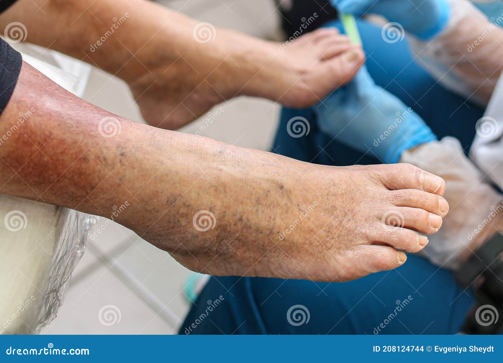 Billy ged strejke discolor Leg Vein Disease, Dark Spots on the Skin of the Legs, Treatment, Examination of Toenails, Fungus. Phlebologist Stock Photo - Image of care, healthcare: 208124744 Billy ged strejke discolor Leg Vein Disease, Dark Spots on the Skin of the Legs, Treatment, Examination of Toenails, Fungus. Phlebologist Stock Photo - Image of care, healthcare: 208124744