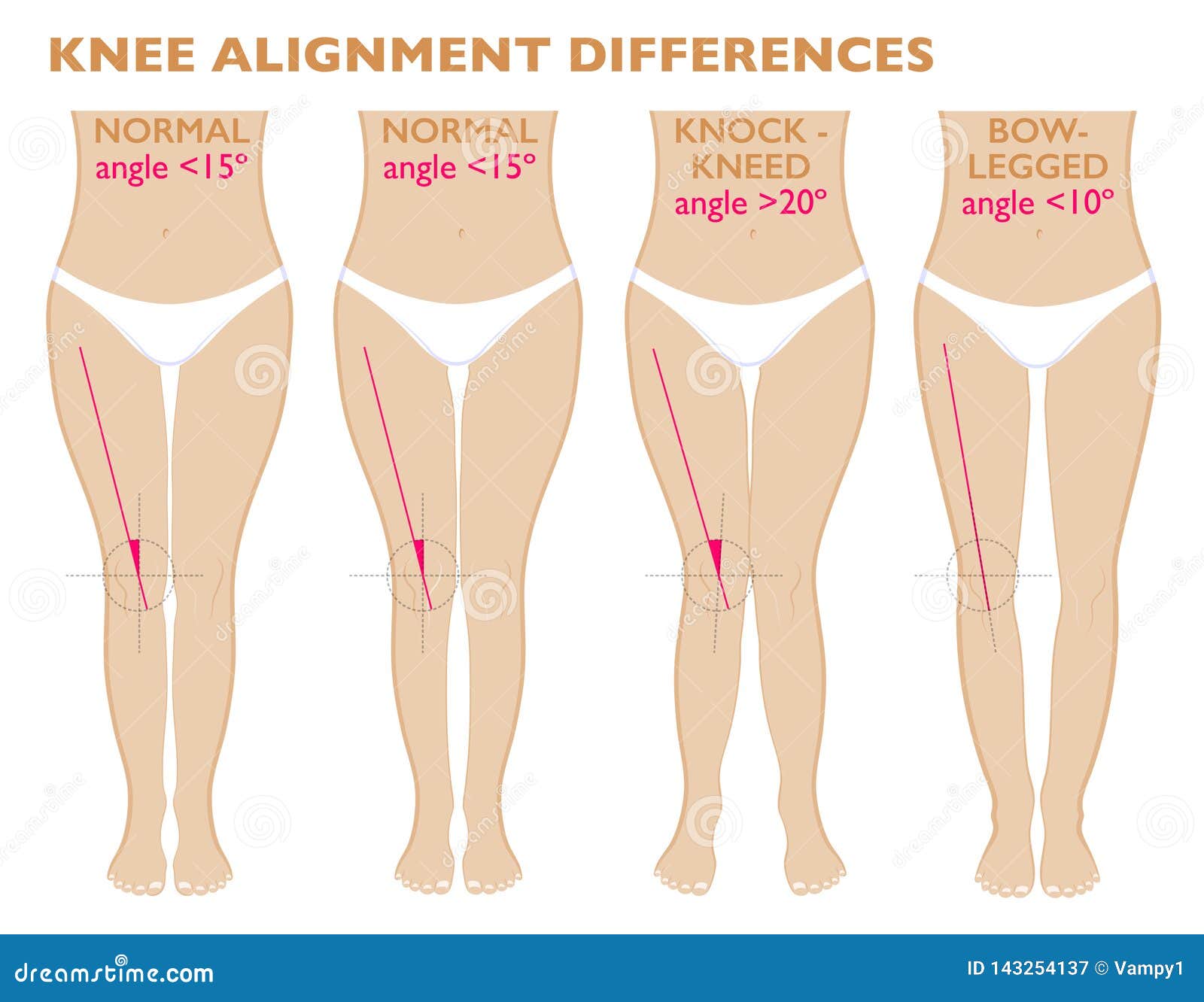 Legs and Angles of the Knees, Different Types of Leg Shapes. Normal Varus  and Valgus Stock Vector - Illustration of disease, cartilage: 143254137