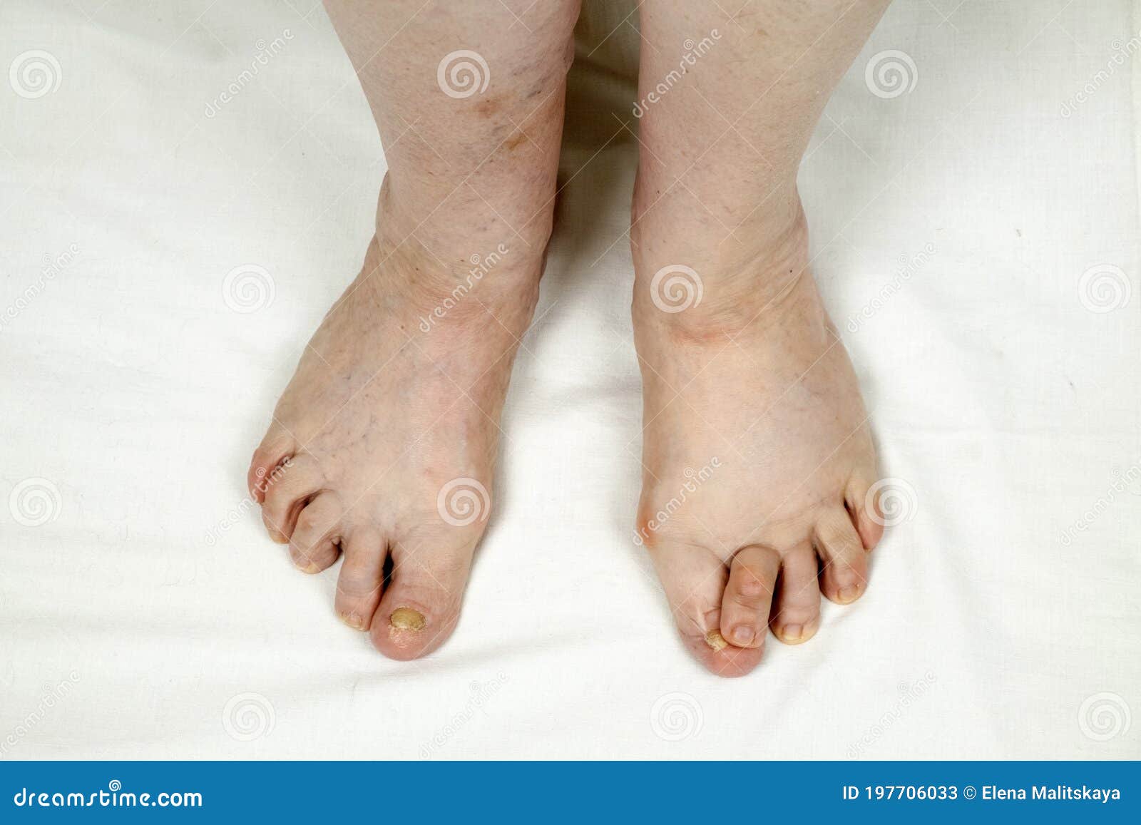 Legs of an Elderly Woman with Rheumatoid Arthritis Stock Image Image