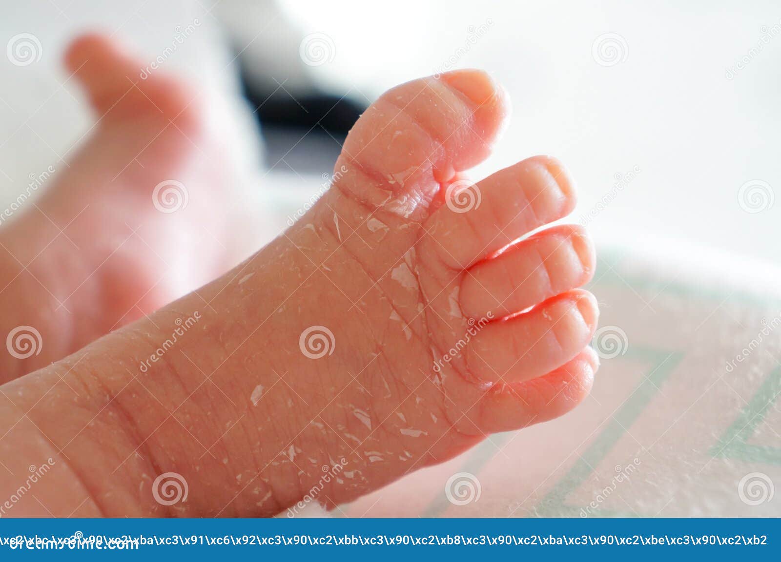 Legs of a Newborn Peeling Skin Stock Photo Image of little, life