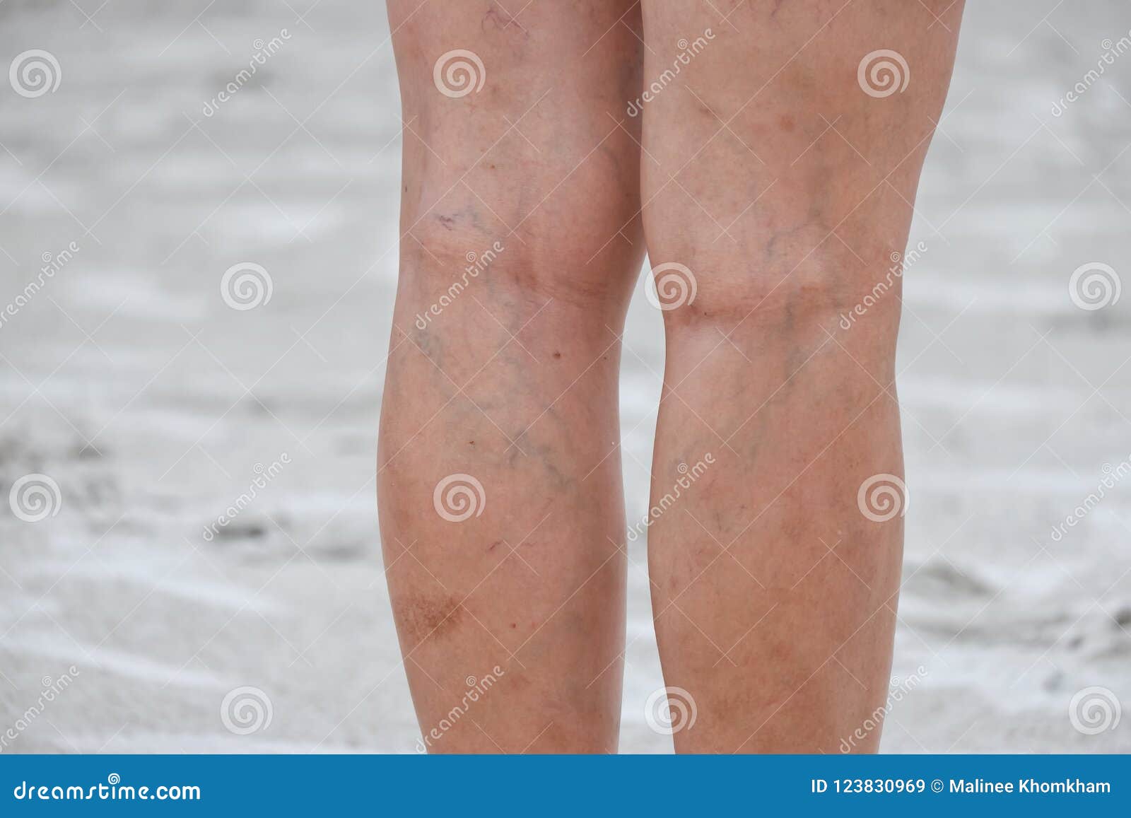 legs of women, scars and varicose veins.