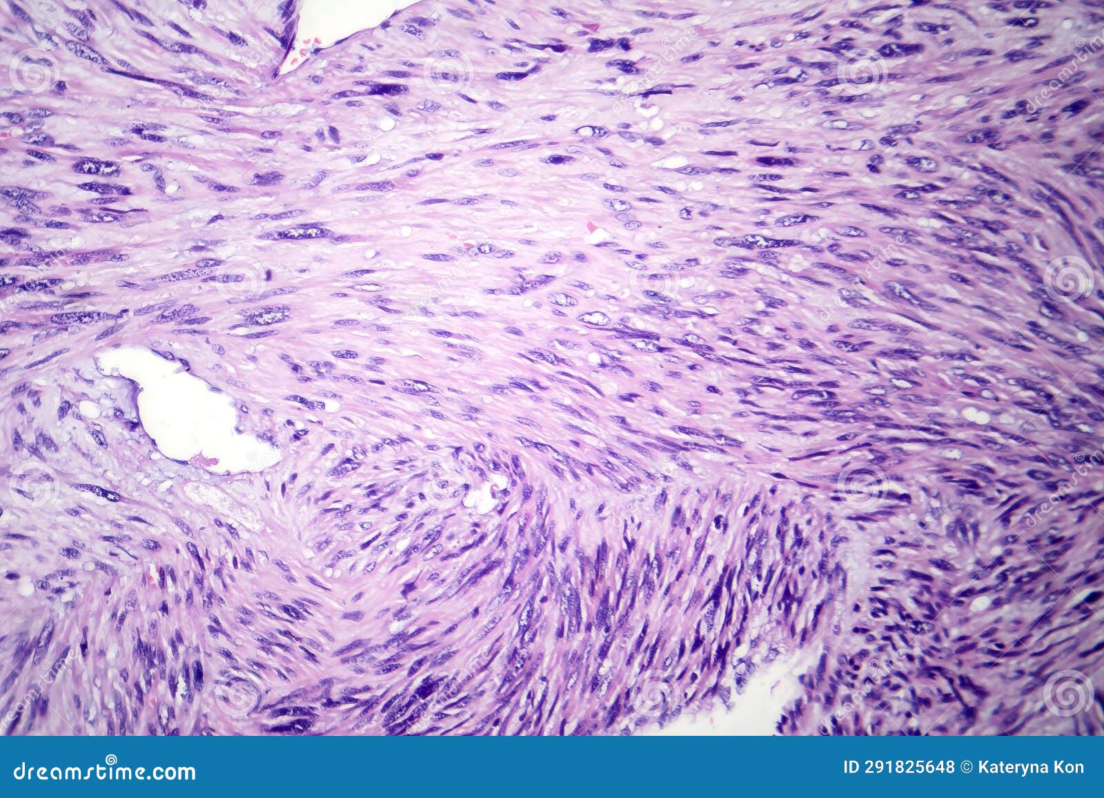 leiomyosarcoma, light micrograph