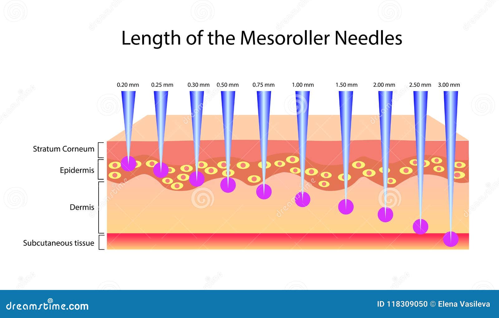 length of the mesoroller needles,  