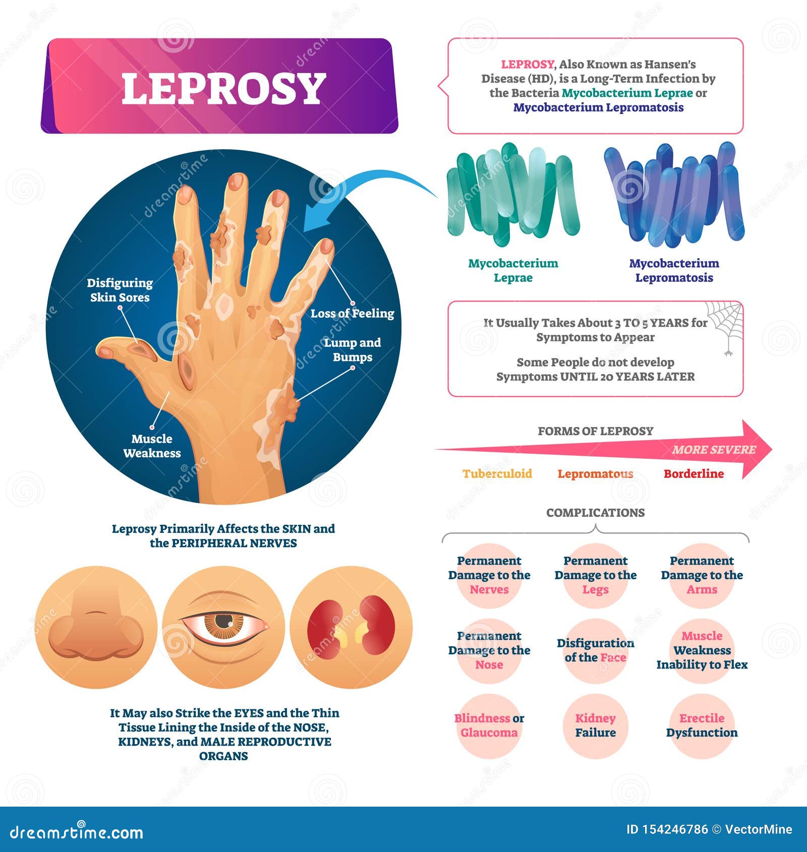leprosy  . labeled medical bacterial infection disease.