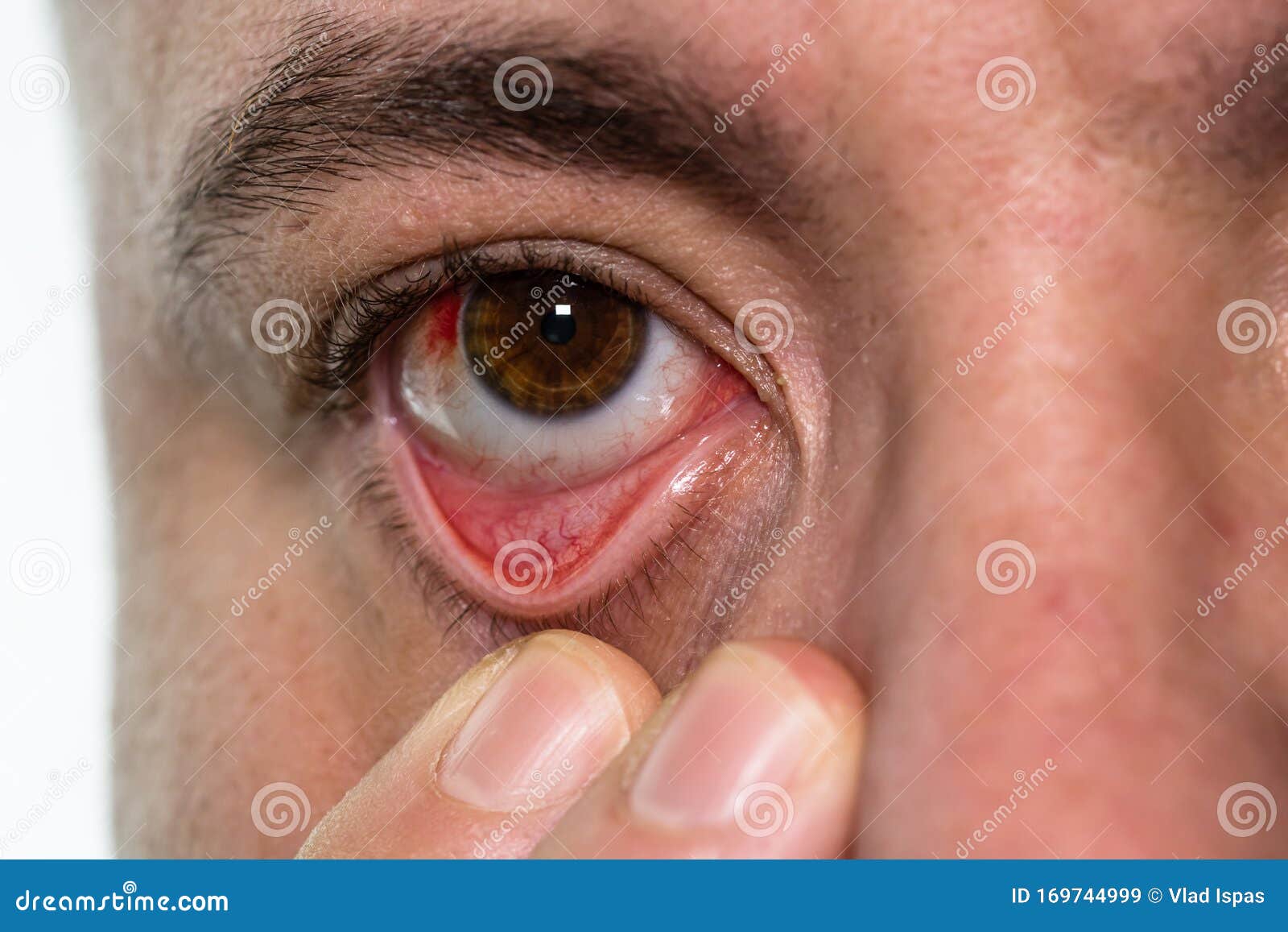 Lesión Ocular, Con Un Vaso Sanguíneo En El Ojo, Fatiga, Problemas Los Vasos Sanguíneos Imagen de archivo - Imagen ojos, eyeball: 169744999