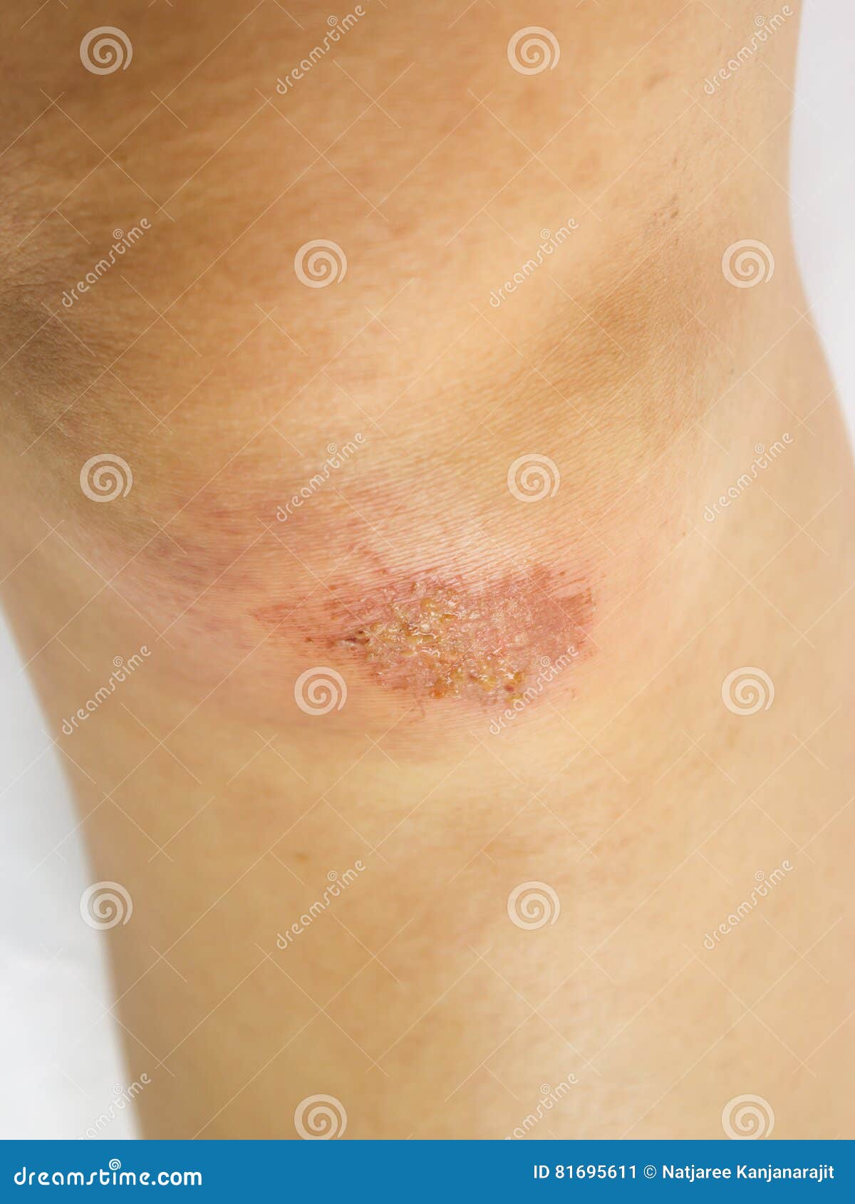 Lesion on knee. stock image. Image of body, health, scar 81695611