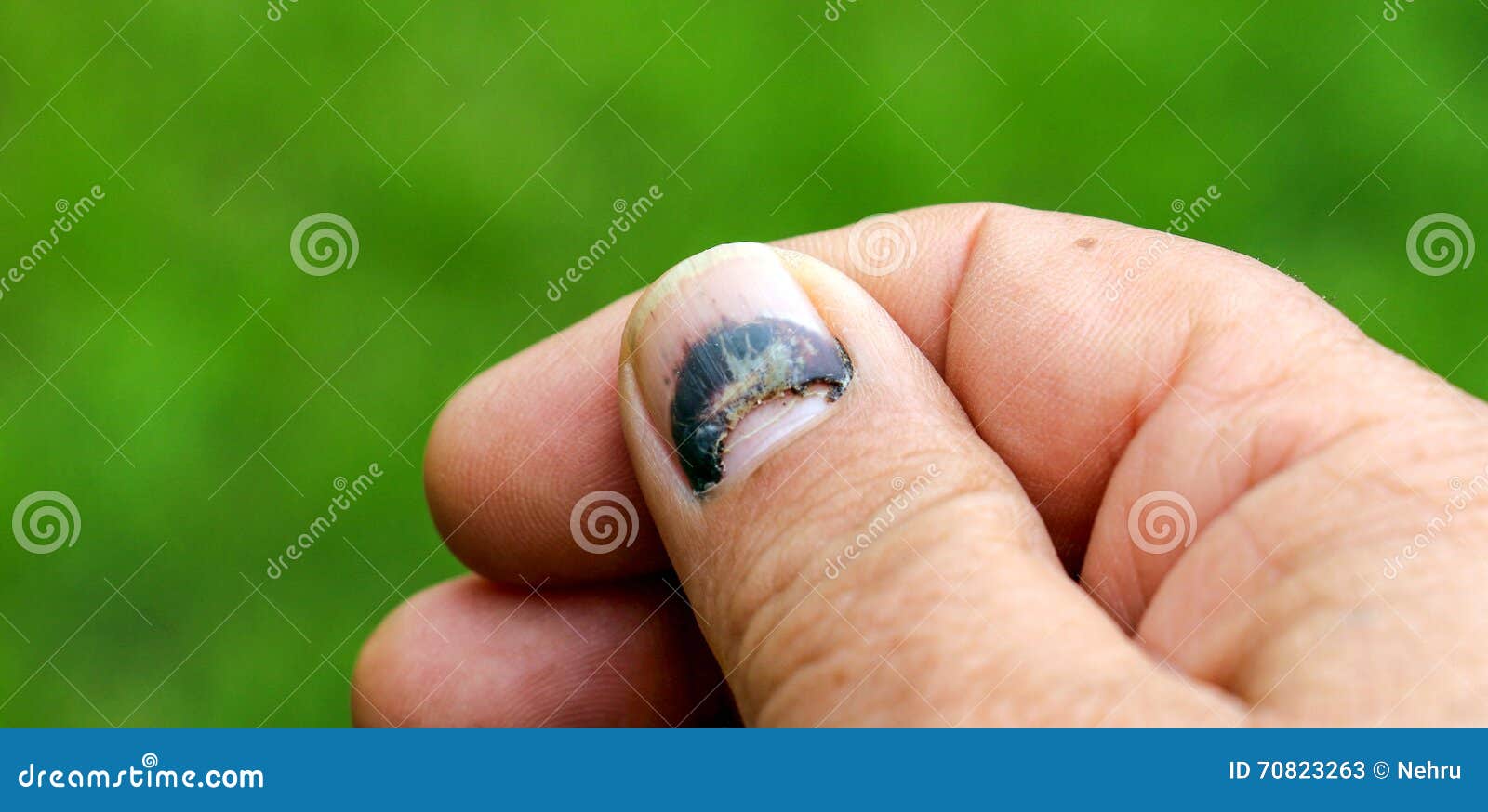 Lesione Fisica Unghia Umana Ferita Del Dito Della Mano Immagine Stock