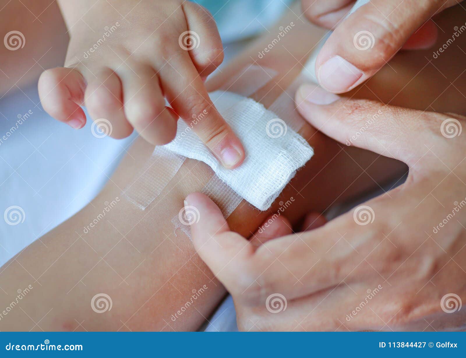 Lesions of the knee. stock image. Image of health, bruise 113844427