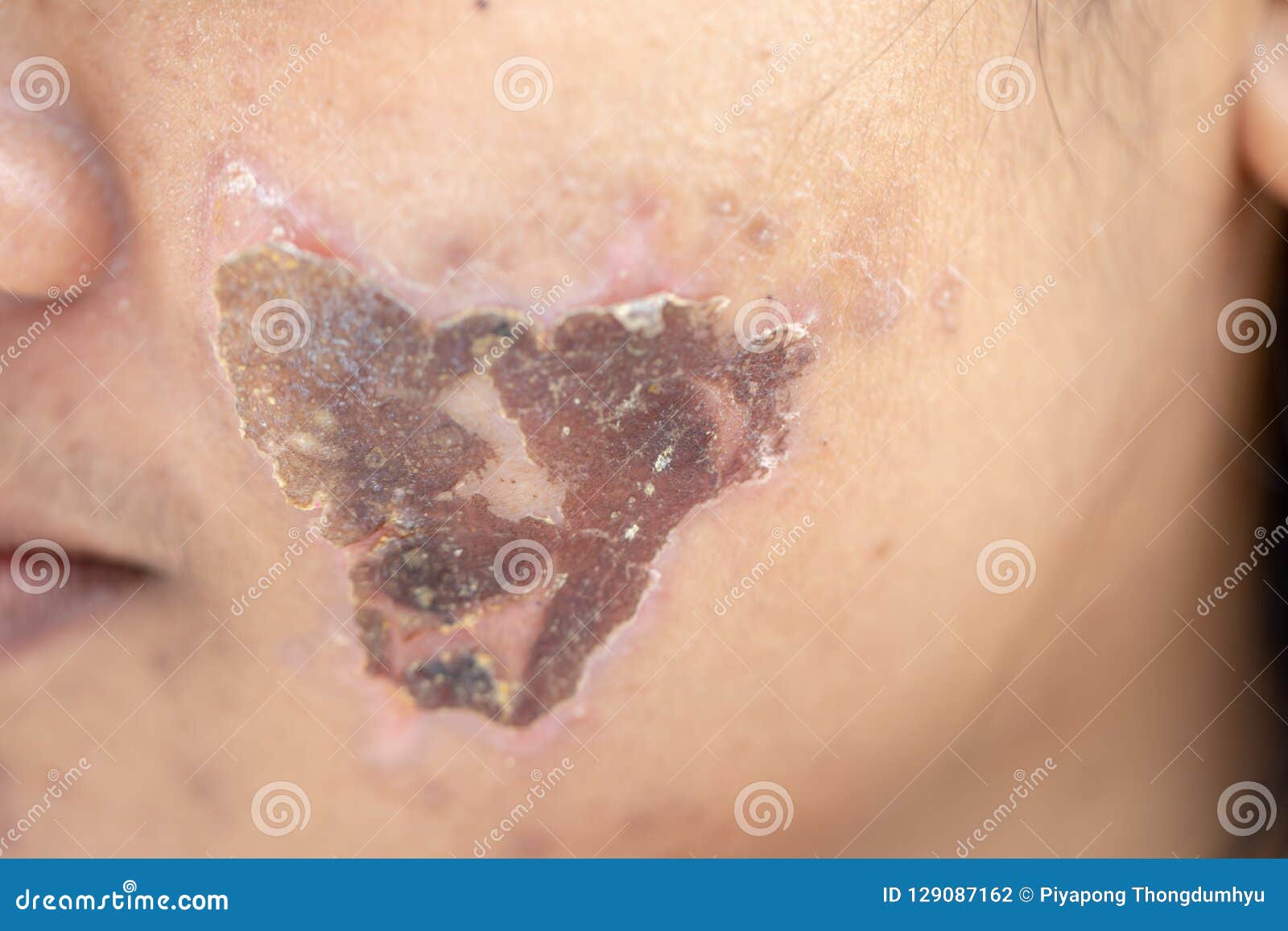 Lesions Skin Caused By Acne On The Face In The Clinic Royalty Free