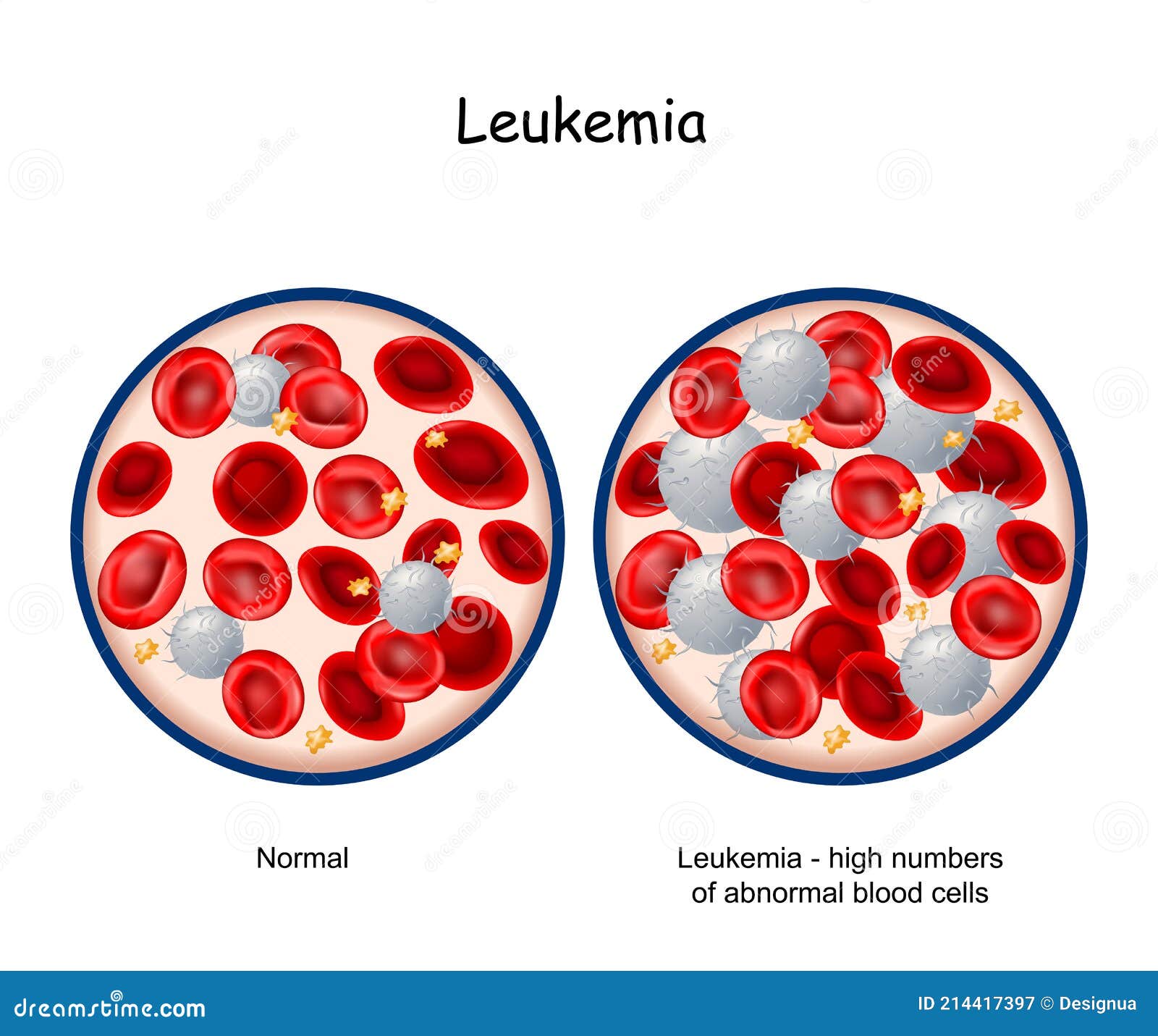 leukemia cells vs normal cells