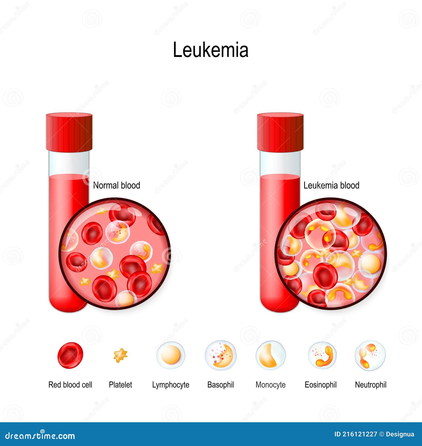 leukemia cells vs normal cells