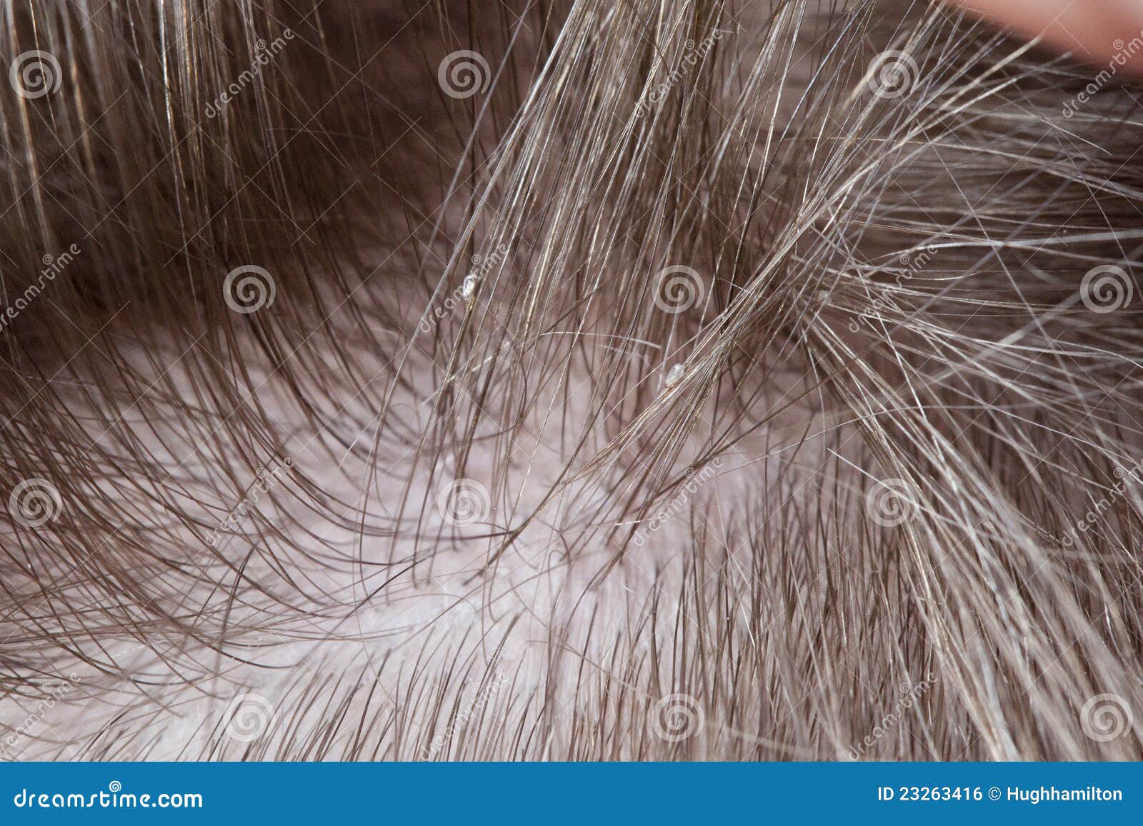 Lice Stock Photo Image Of Infestation Nits Hair Lice 23263416
