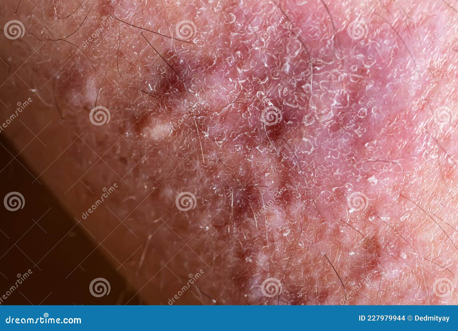 Lichen Planus On Leg Skin Close Up Dermatological Disease In Form Of