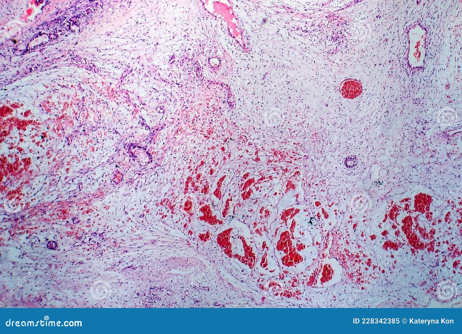 Teratoma, light micrograph stock image. Image of circle - 228342385 Teratoma, light micrograph stock image. Image of circle - 228342385