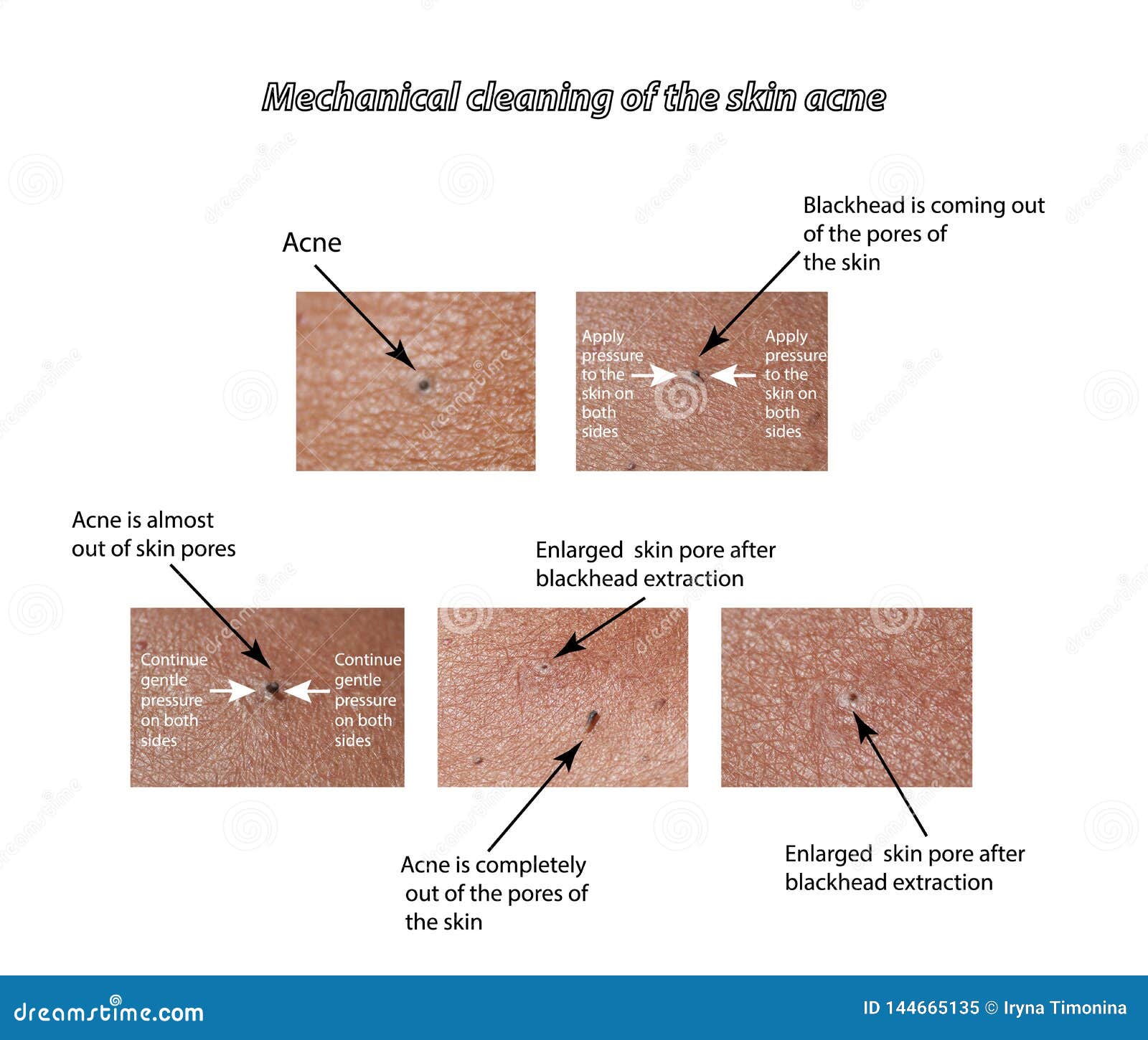 Limpeza Mecânica Da Pele Da Acne Ilustração do Vetor - Ilustração de  bonito, médico: 144665135, image size:1600x1450
