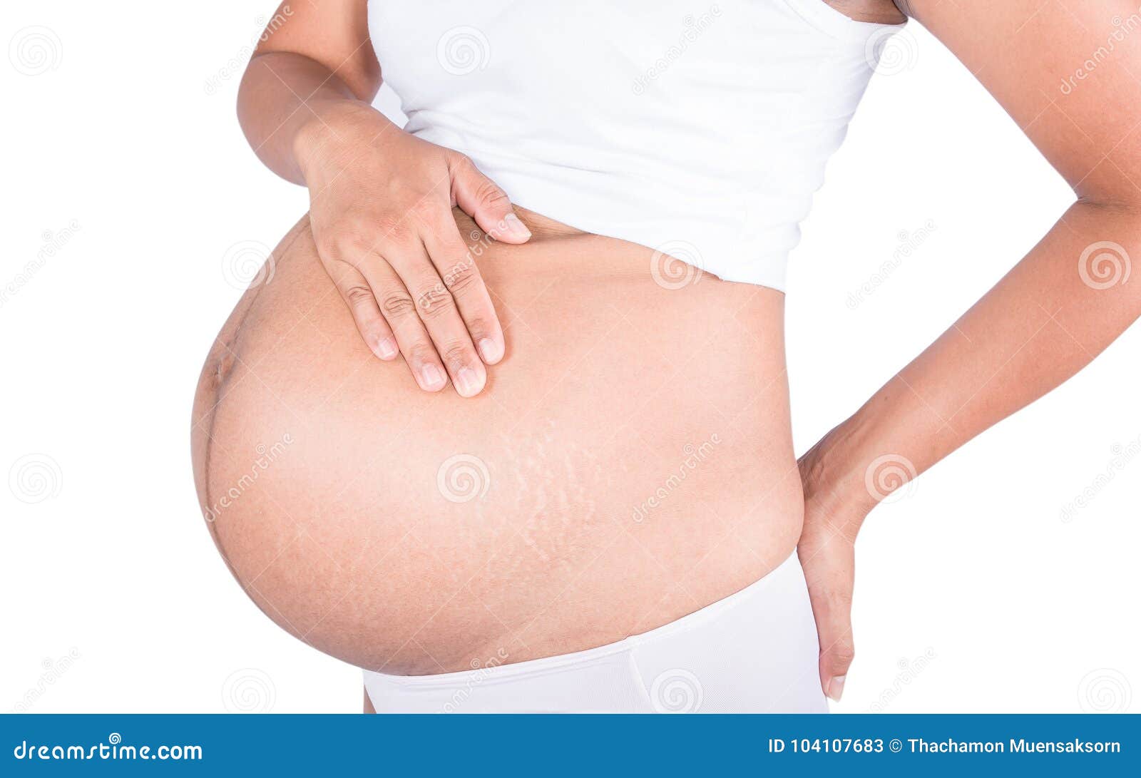 linea nigra and stretch marks on pregnant women