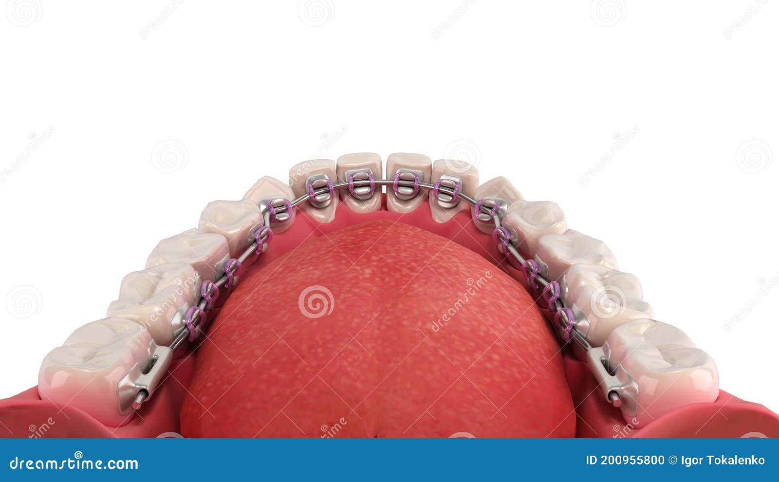 Lingual Braces System on a Demonstration Denture 3d on White Stock