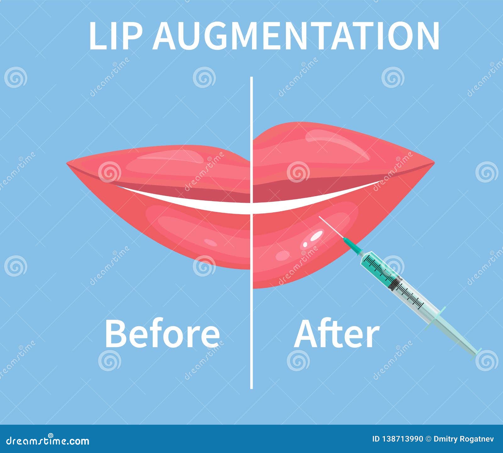 Lip Filler Before And After Cartoon Vector CartoonDealer 20899995 lip-filler-before-and-after-cartoon-vector-cartoondealer-20899995