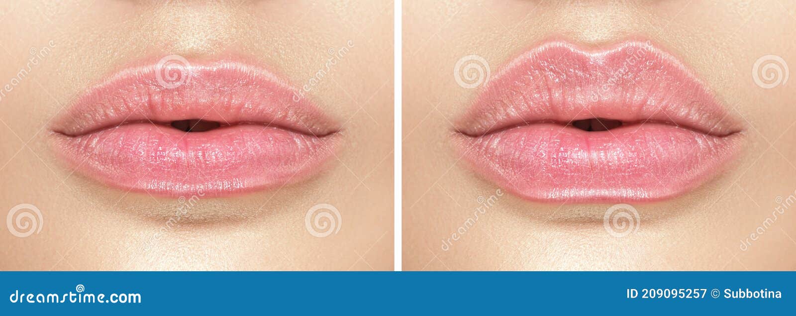 before and after lip filler injections. fillers. lip augmentation beautiful perfect lips. sexy mouth close-up. plastic surgery