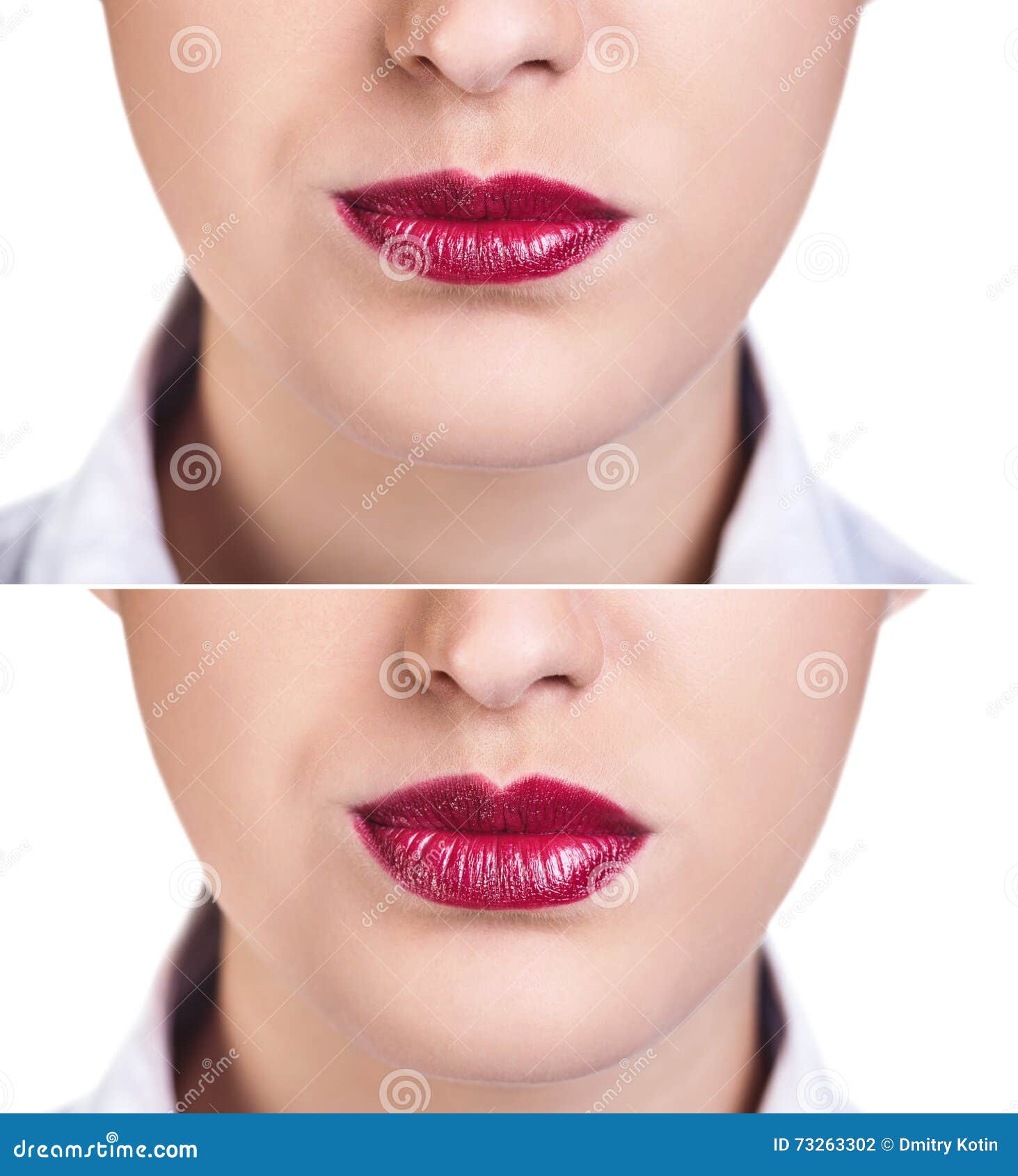 Before And After Lip Filler Injections. Stock Photo Image of natural