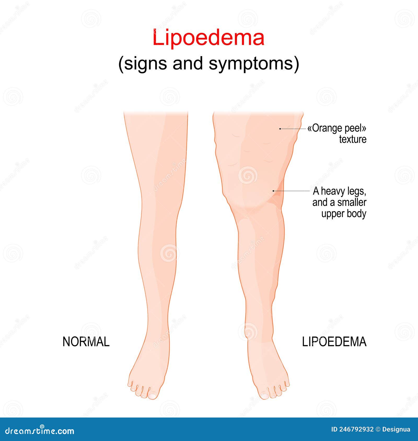 Lipedema ou lipedema ilustração do vetor. Ilustração de adiposo