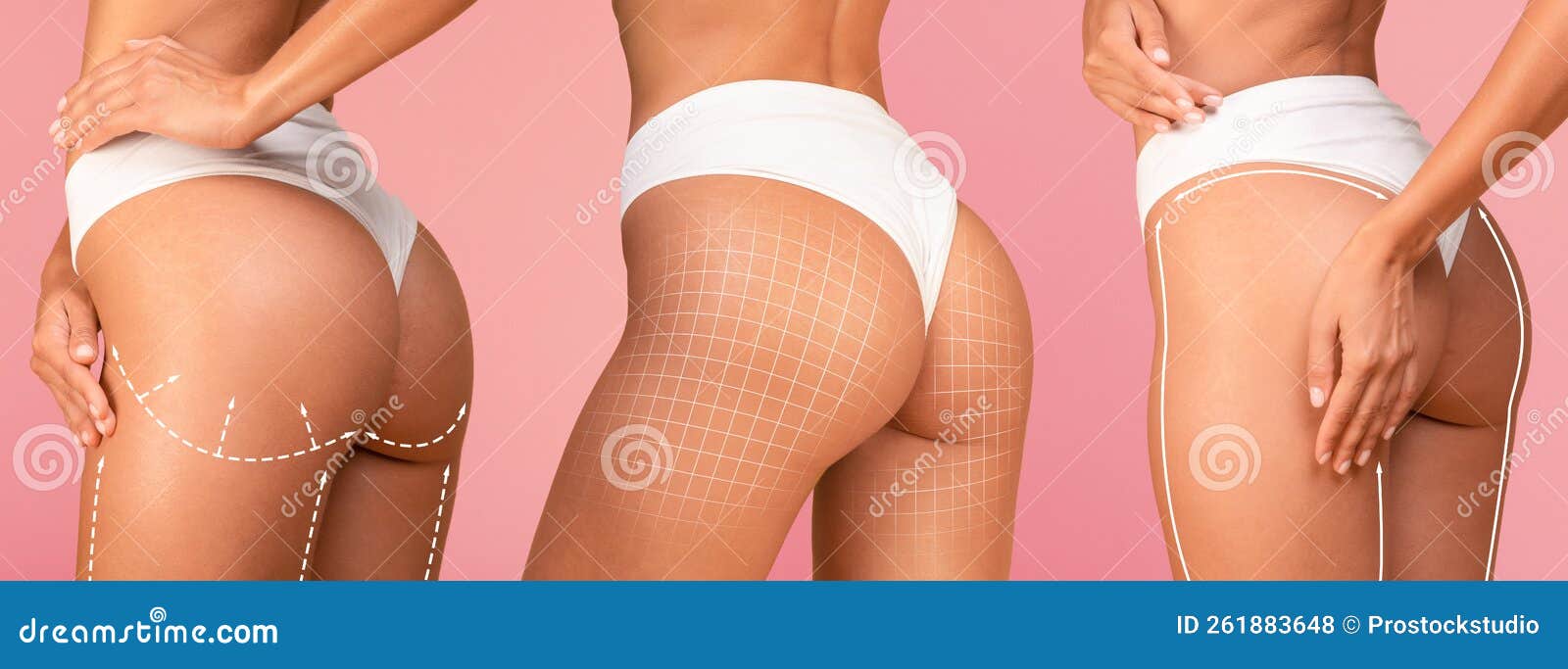 Lipolysis Treatment. Collage with Female in Underwear with Perfect Buttocks  Stock Photo - Image of fitness, anticellulite: 261883648
