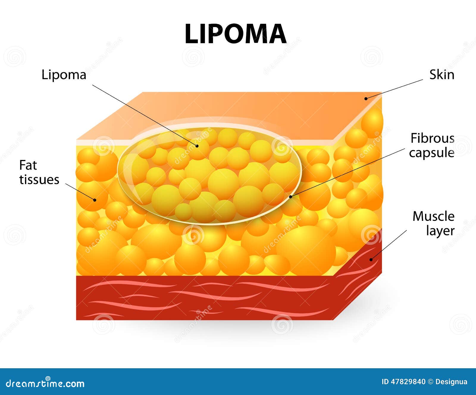 Lipoma - Symptoms, Pictures, Causes, Removal, Surgery ...