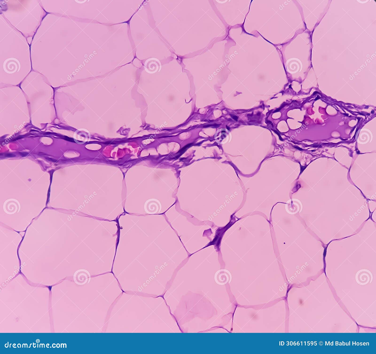 lipoma on cubital fossa, benign growth of fatty tissue, benign neoplasm, adipocytes, partially capsulated tumor, 40x microscopic v