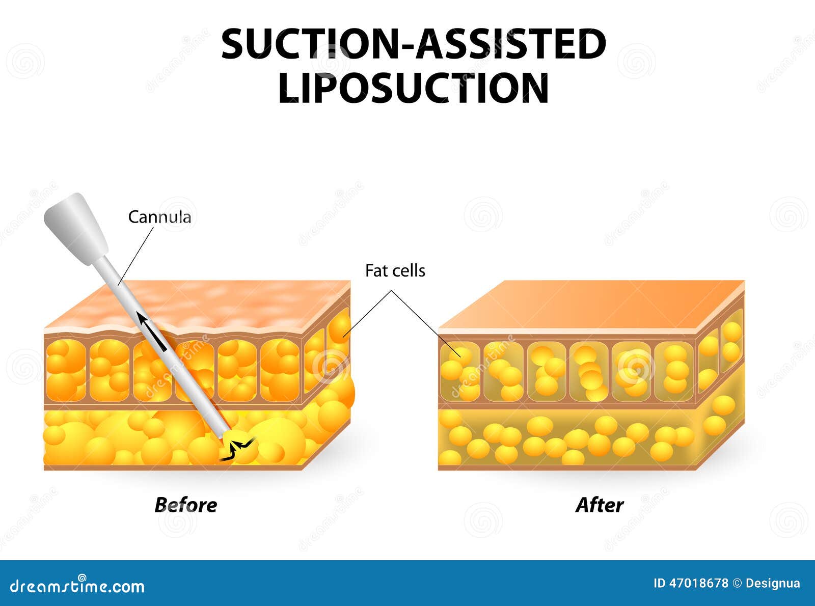 Μηχανισμός του liposuction Αναρρόφηση-βοηθημένο liposuction κοίλος σωλήνας (κάννουλα) που παρεμβάλλεται μέσω μιας μικρής τομής στο λίπος δερμάτων προκειμένου από το σώμα