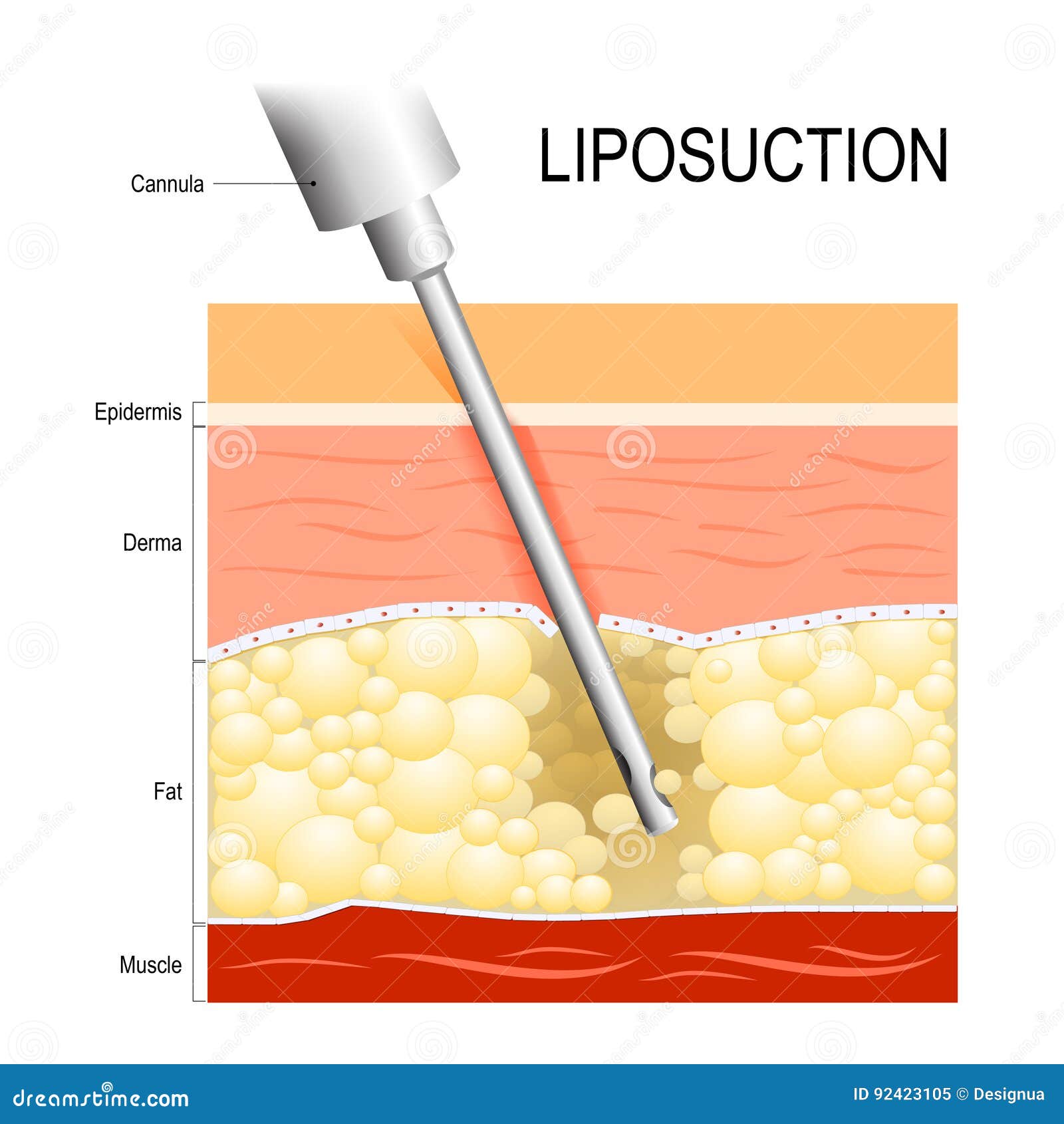 liposuction. cannula into the fat layer beneath skin.