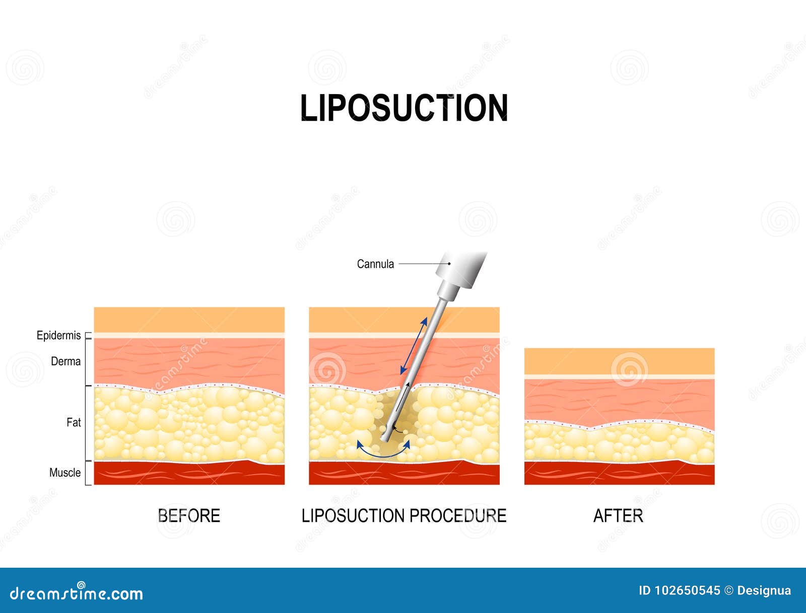 liposuction procedure. before and after