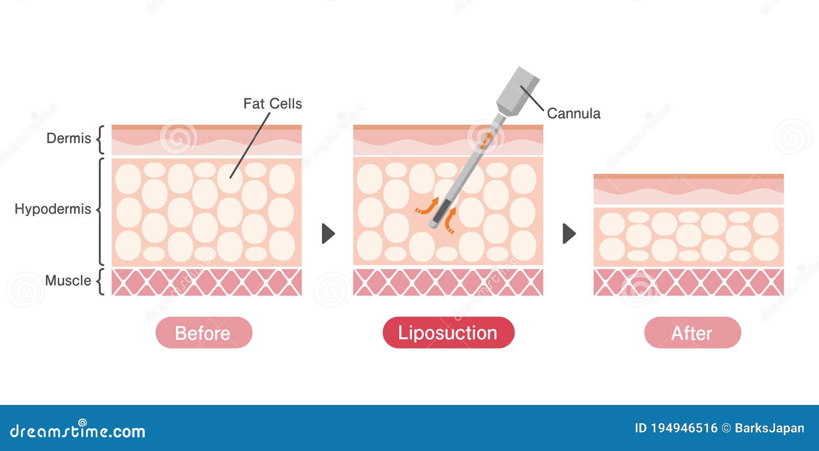 liposuction process   / sectional view of skin